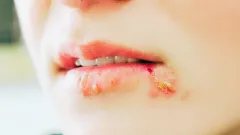 Dudakta Uçuk: Neden Çıkar, Nasıl Geçer? En Hızlı Uçuk Tedavisi - Kaleli